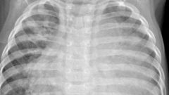 Röntgen filmlerinden coronayı teşhis eden sistem geliştirdi