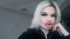 Dünyanın en büyük dudaklarına sahipti! Yeni rekora koşuyor