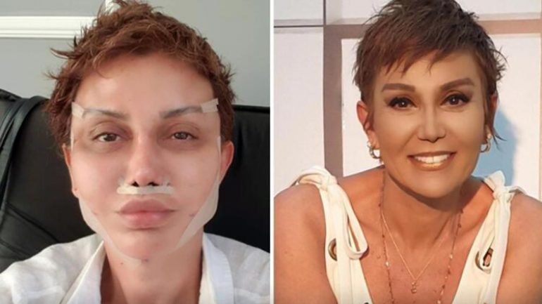 Estetik operasyonu geçiren Serap Paköz son halini ‘Photoshopsuz’ notuyla paylaştı