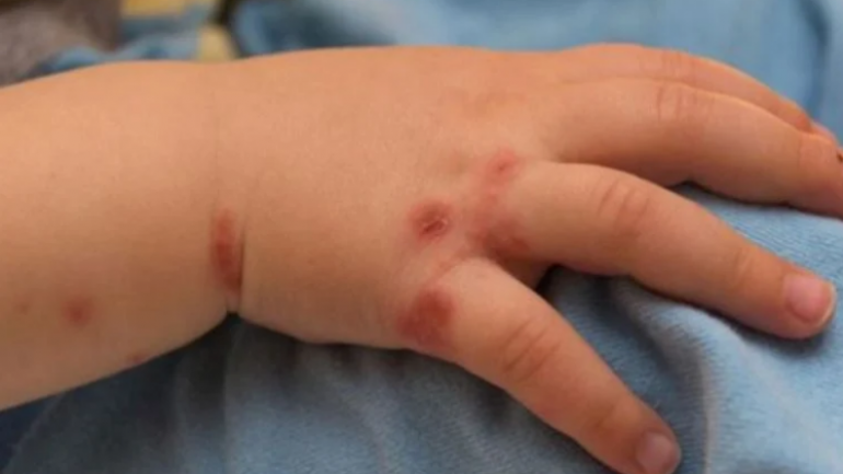 Hindistan’da 82 çocukta ‘domates gribi’ tespit edildi