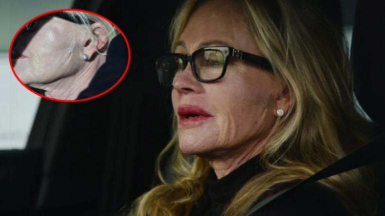 Cilt kanserini yenmişti… Melanie Griffith’in yüzündeki yara izi endişelendirdi